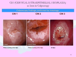 16
CIN (CERVICAL INTRAEPITHELIAL NEOPLASIA)CIN (CERVICAL INTRAEPITHELIAL NEOPLASIA)
as Seen in Colposcopyas Seen in Colposcopy
CIN 1 CIN 2 CIN 3
Photo courtesy of Dr. Njue Photo courtesy of Dr. Njue Dr.Njue
Colposcopy findings confirmed by histologyColposcopy findings confirmed by histology11
 