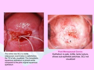 Post Menopausal Cervix:
Epithelium is pale, brittle, lacks lusture,
shows sub-epithelial petichiae, SCJ not
visualized
The entire new SCJ is visible
colposcopic examination is satisfactory.
the TZ is fully visualized. The metaplastic
squamous epithelium is pinkish-white
compared to the pink original squamous
epithelium
 