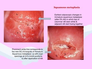 Squamous metaplasia
Earliest colposcopic changes in
immature squamous metaplasia
(after 5% AA) in which tips of
columnar villi stain white &
adjacent villi start fusing together
Prominent white line corresponds to
the new SCJ & tongues of immature
Squamous metaplasia a) with crypt
openings at 4-8 o’clock positions
b) after application of AA
 