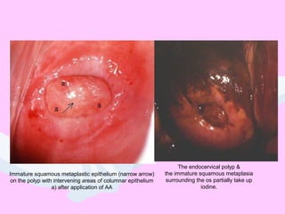 Immature squamous metaplastic epithelium (narrow arrow)
on the polyp with intervening areas of columnar epithelium
a) after application of AA
The endocervical polyp &
the immature squamous metaplasia
surrounding the os partially take up
iodine.
 
