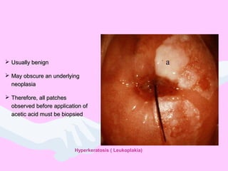 LeukoplakiaLeukoplakia
 Usually benignUsually benign
 May obscure an underlyingMay obscure an underlying
neoplasianeoplasia
 Therefore, all patchesTherefore, all patches
observed before application ofobserved before application of
acetic acid must be biopsiedacetic acid must be biopsied
Hyperkeratosis ( Leukoplakia)
 