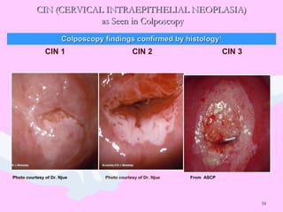 54
CIN (CERVICAL INTRAEPITHELIAL NEOPLASIA)CIN (CERVICAL INTRAEPITHELIAL NEOPLASIA)
as Seen in Colposcopyas Seen in Colposcopy
CIN 1 CIN 2 CIN 3
Photo courtesy of Dr. Njue Photo courtesy of Dr. Njue From ASCP
Colposcopy findings confirmed by histologyColposcopy findings confirmed by histology11
 