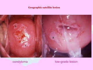Geographic satellite lesion
condyloma low-grade lesion
 