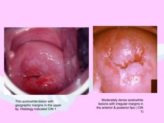 Thin acetowhite lesion with
geographic margins in the upper
lip. Histology indicated CIN 1
Moderately dense acetowhite
lesions with irregular margins in
the anterior & posterior lips ( CIN
1)
 