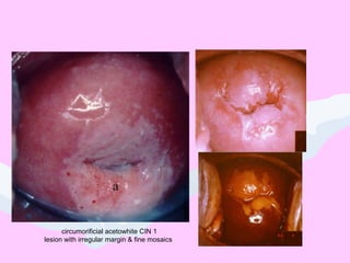circumorificial acetowhite CIN 1
lesion with irregular margin & fine mosaics
 