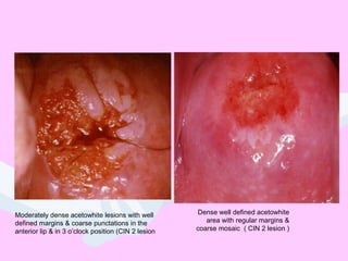 Moderately dense acetowhite lesions with well
defined margins & coarse punctations in the
anterior lip & in 3 o’clock position (CIN 2 lesion
Dense well defined acetowhite
area with regular margins &
coarse mosaic ( CIN 2 lesion )
 