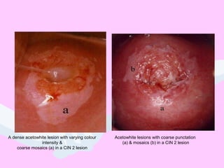 A dense acetowhite lesion with varying colour
intensity &
coarse mosaics (a) in a CIN 2 lesion
Acetowhite lesions with coarse punctation
(a) & mosaics (b) in a CIN 2 lesion
 