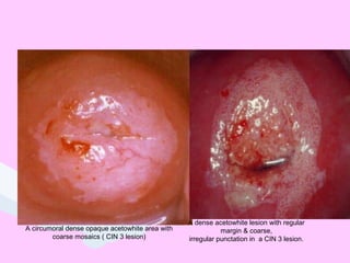 A circumoral dense opaque acetowhite area with
coarse mosaics ( CIN 3 lesion)
A dense acetowhite lesion with regular
margin & coarse,
irregular punctation in a CIN 3 lesion.
 