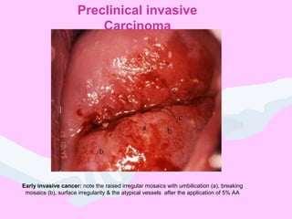 Early invasive cancer: note the raised irregular mosaics with umbilication (a), breaking
mosaics (b), surface irregularity & the atypical vessels after the application of 5% AA
Preclinical invasive
Carcinoma
 