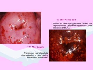 TV after Acetic acid
T.V. After Lugol’s
Multiple red spots (a) suggestive of Trichomonas
vaginalis colpitis ( strawberry appearance), after
application of 5% AA
Trichomonas vaginalis colpitis
after application of Lugol’s iodine
(leopard-skin appearance)
 