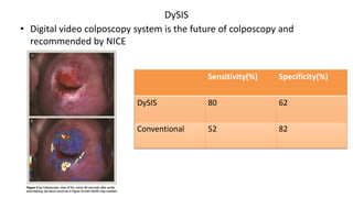 DySIS
• Digital video colposcopy system is the future of colposcopy and
recommended by NICE
Sensitivity(%) Specificity(%)
DySIS 80 62
Conventional 52 82
 