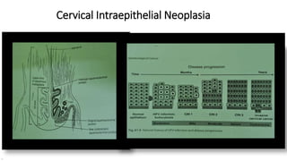 Cervical Intraepithelial Neoplasia
 