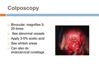 Colposcopy
 Binocular, magnifies 5-
20 times
 See abnormal vessels
 Apply 3-5% acetic acid
 See whitish areas
 Can also do
endocervical curettage
 