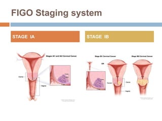 FIGO Staging system
STAGE IA STAGE IB
 