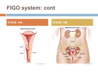 FIGO system: cont
STAGE IIIA STAGE IIIB
 