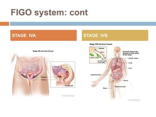FIGO system: cont
STAGE IVA STAGE IVB
 