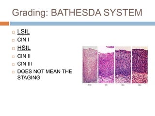 Grading: BATHESDA SYSTEM
 LSIL
 CIN I
 HSIL
 CIN II
 CIN III
 DOES NOT MEAN THE
STAGING
 