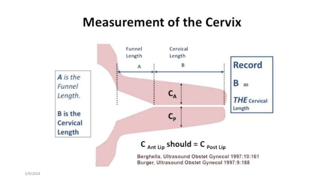 cervical cerclage.pptx | Pregnancy | Reproductive Health