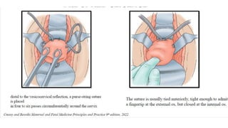 cervical cerclage.pptx
