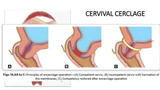 CERVIVAL CERCLAGE
Provide structural support
to “weak” cervix.
Maintain cervical length and
the endocervical mucus plug
as a mechanical barrier to
ascending infection.
1/9/2024
Principle: The procedure reinforces the weak cervix by
a nonabsorbable tape, placed around the cervix at the
level of internal os.
 