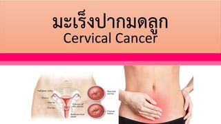 มะเร็งปากมดลูก
Cervical Cancer
 