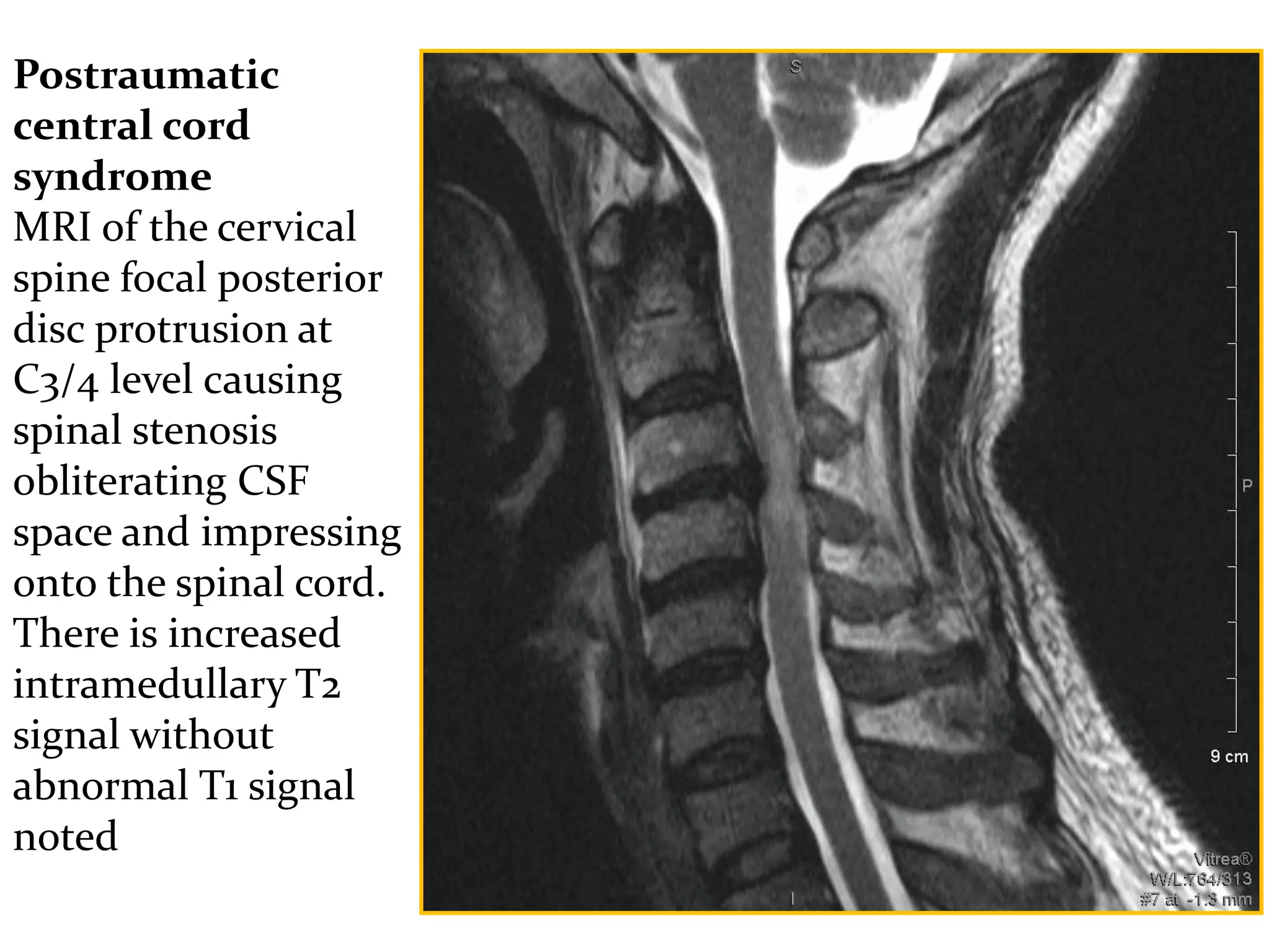 Postraumatic
central cord
syndrome
MRI of the cervical
spine focal posterior
disc protrusion at
C3/4 level causing
spinal stenosis
obliterating CSF
space and impressing
onto the spinal cord.
There is increased
intramedullary T2
signal without
abnormal T1 signal
noted