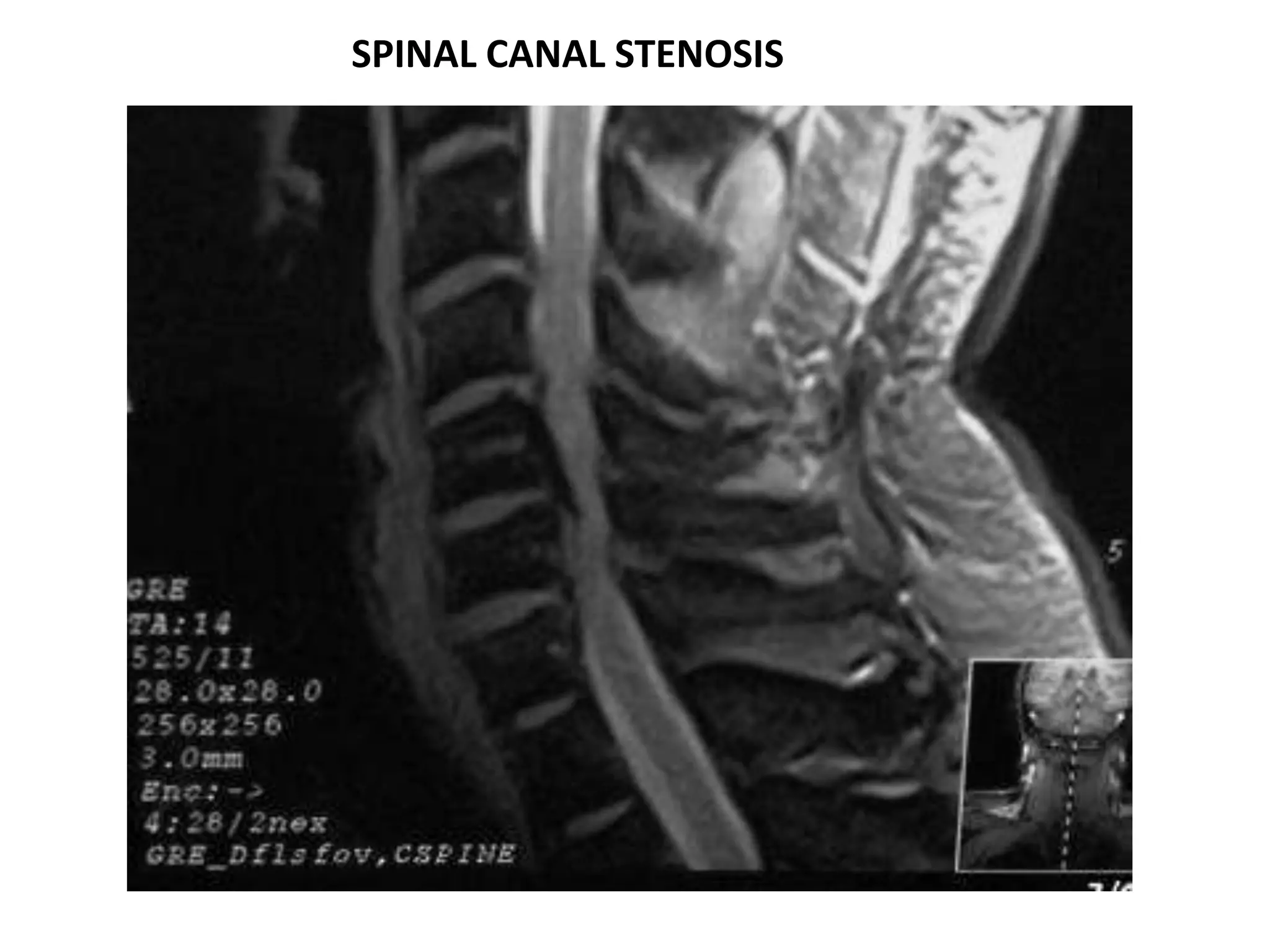 SPINAL CANAL STENOSIS