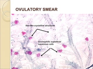 OVULATORY SMEAR 
fern-like crystalline structures 
eosinophilic superficial 
squamous cells 
dr. monika nema 
 