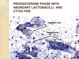 PROGESTERONE PHASE WITH 
ABUNDANT LACTOBACILLI AND 
CYTOLYSIS 
navicular cells 
Naked nuclei 
dr. monika nema 
 