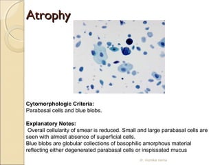 AAttrroopphhyy 
Cytomorphologic Criteria: 
Parabasal cells and blue blobs. 
Explanatory Notes: 
Overall cellularity of smear is reduced. Small and large parabasal cells are 
seen with almost absence of superficial cells. 
Blue blobs are globular collections of basophilic amorphous material 
reflecting either degenerated parabasal cells or inspissated mucus 
dr. monika nema 
 
