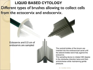 LIQUID BASED CYTOLOGY 
a Different types of brushes alllloowwiinngg ttoo ccoolllleecctt cceellllss 
ffrroomm tthhee eeccttoocceerrvviixx aanndd eennddoocceerrvviixx.. 
Ectocervix and 0.5 cm of 
endocervix are sampled 
The central bristles of the broom are 
inserted into the endocervical canal until 
the lateral bristles bend fully against the 
ectocervix. 
The sampling device is rotated 360 degree 
in the clockwise direction twice and then 
anticlockwise while maintaining gentle 
pressure. 
dr. monika nema 
 