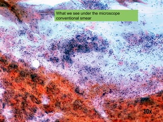 What we see under the microscope 
conventional smear 
dr. monika nema 
 