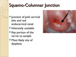 SSqquuaammoo--CCoolluummnnaarr JJuunnccttiioonn 
Junction of pink cervical 
skin and red 
endocervical canal 
Inherently unstable 
Key portion of the 
cervix to sample 
Most likely site of 
dysplasia 
 