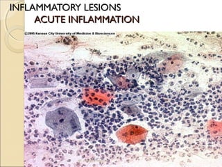 IINNFFLLAAMMMMAATTOORRYY LLEESSIIOONNSS 
AACCUUTTEE IINNFFLLAAMMMMAATTIIOONN 
dr. monika nema 
 