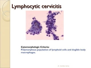 LLyymmpphhooccyyttiicc cceerrvviicciittiiss 
Cytomorphologic Criteria: 
Polymorphous population of lymphoid cells and tingible body 
macrophages. 
dr. monika nema 
 