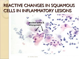RREEAACCTTIIVVEE CCHHAANNGGEESS IINN SSQQUUAAMMOOUUSS 
CCEELLLLSS IINN IINNFFLLAAMMMMAATTOORRYY LLEESSIIOONNSS 
Nuclear pallor & 
enlargement 
dr. monika nema 
 