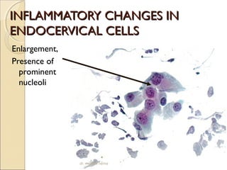 IINNFFLLAAMMMMAATTOORRYY CCHHAANNGGEESS IINN 
EENNDDOOCCEERRVVIICCAALL CCEELLLLSS 
Enlargement, 
Presence of 
prominent 
nucleoli 
dr. monika nema 
 