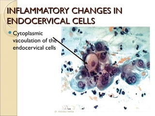 IINNFFLLAAMMMMAATTOORRYY CCHHAANNGGEESS IINN 
EENNDDOOCCEERRVVIICCAALL CCEELLLLSS 
Cytoplasmic 
vacoulation of the 
endocervical cells 
dr. monika nema 
 