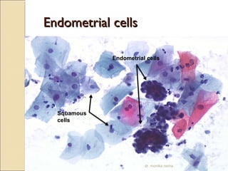 EEnnddoommeettrriiaall cceellllss 
Squamous 
cells 
Endometrial cells 
dr. monika nema 
 