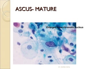 AASSCCUUSS-- MMAATTUURREE 
Enlarged hyperchromatic nucleus 
dr. monika nema 
 