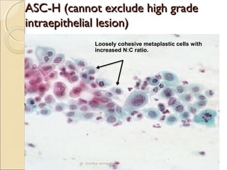 AASSCC--HH ((ccaannnnoott eexxcclluuddee hhiigghh ggrraaddee 
iinnttrraaeeppiitthheelliiaall lleessiioonn)) 
Loosely cohesive metaplastic cells with 
increased N:C ratio. 
dr. monika nema 
 