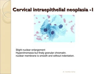 Cervical iinnttrraaeeppiitthheelliiaall nneeooppllaassiiaa --11 
Slight nuclear enlargement 
Hyperchromasia but finely granular chromatin. 
nuclear membrane is smooth and without indentation. 
dr. monika nema 
 