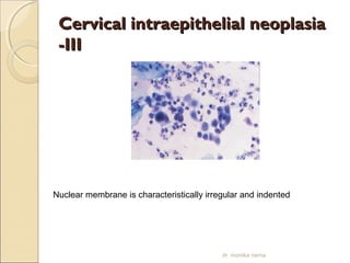 Cervical iinnttrraaeeppiitthheelliiaall nneeooppllaassiiaa 
--IIIIII 
Nuclear membrane is characteristically irregular and indented 
dr. monika nema 
 