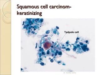 SSqquuaammoouuss cceellll ccaarrcciinnoomm-- 
kkeerraattiinniizziinngg 
Tadpole cell 
dr. monika nema 
 