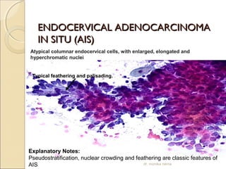 EENNDDOOCCEERRVVIICCAALL AADDEENNOOCCAARRCCIINNOOMMAA 
IINN SSIITTUU ((AAIISS)) 
Atypical columnar endocervical cells, with enlarged, elongated and 
hyperchromatic nuclei. 
Typical feathering and palisading. 
Explanatory Notes: 
Pseudostratification, nuclear crowding and feathering are classic features of 
AIS dr. monika nema 
 