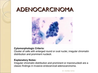 AADDEENNOOCCAARRCCIINNOOMMAA 
Cytomorphologic Criteria: 
Cluster of cells with enlarged round or oval nuclei, irregular chromatin 
distribution and prominent nucleoli. 
Explanatory Notes: 
Irregular chromatin distribution and prominent or macronucleoli are a 
classic findings in invasive endocervical adenocarcinoma. 
dr. monika nema 
 