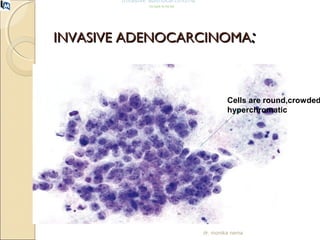 Invasive adenocarcinoma 
Go back to the list 
IINNVVAASSIIVVEE AADDEENNOOCCAARRCCIINNOOMMAA:: 
Cells are round,crowded, 
hyperchromatic 
dr. monika nema 
 