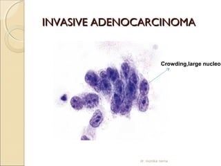 IINNVVAASSIIVVEE AADDEENNOOCCAARRCCIINNOOMMAA 
Crowding,large nucleoli 
dr. monika nema 
 
