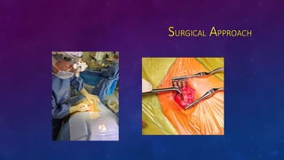 SURGICAL APPROACH
 