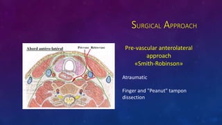 SURGICAL APPROACH
Pre-vascular anterolateral
approach
?Smith-Robinson?
Atraumatic
Finger and "Peanut" tampon
dissection
 